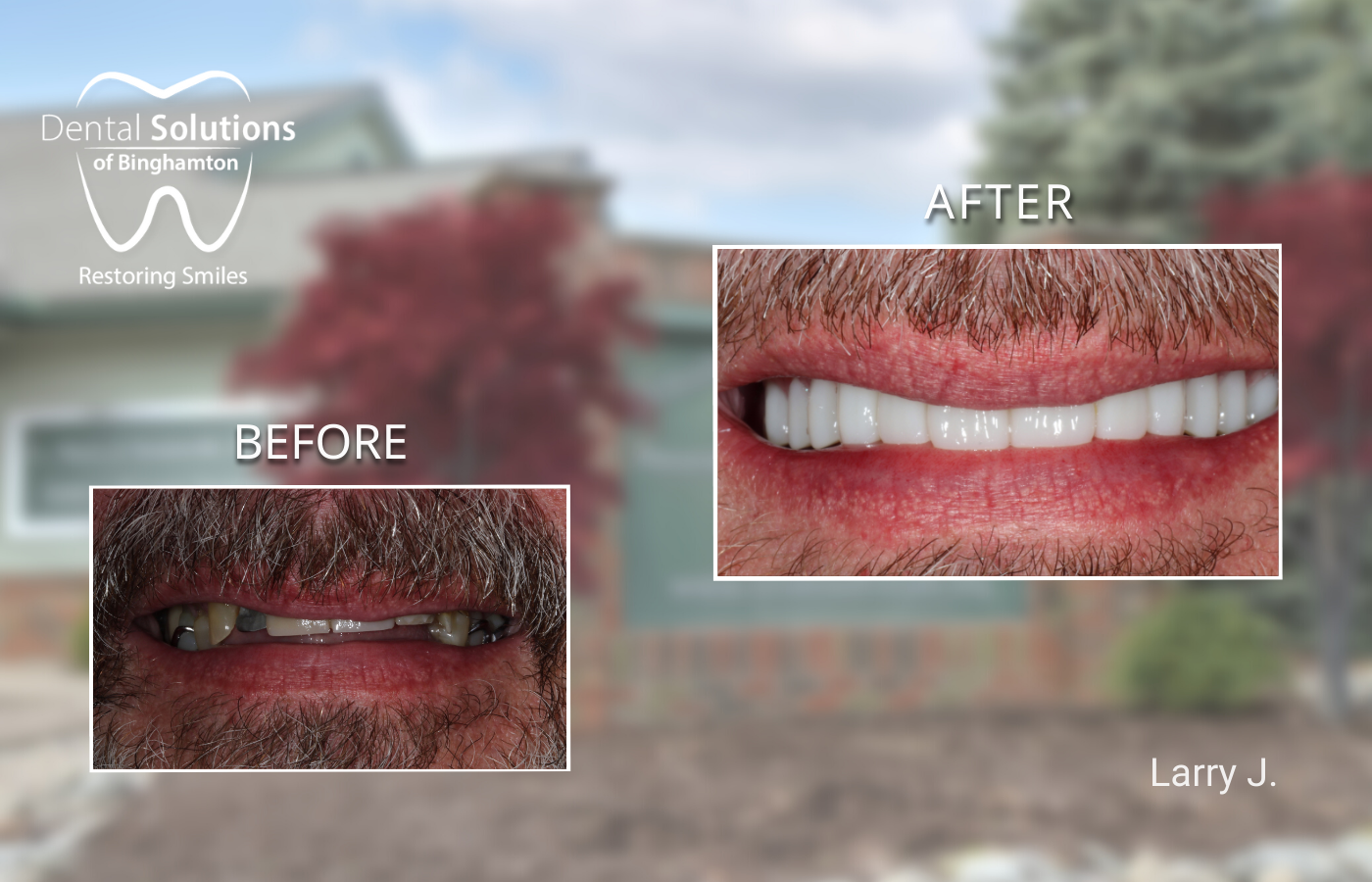 Full Arch Restoration